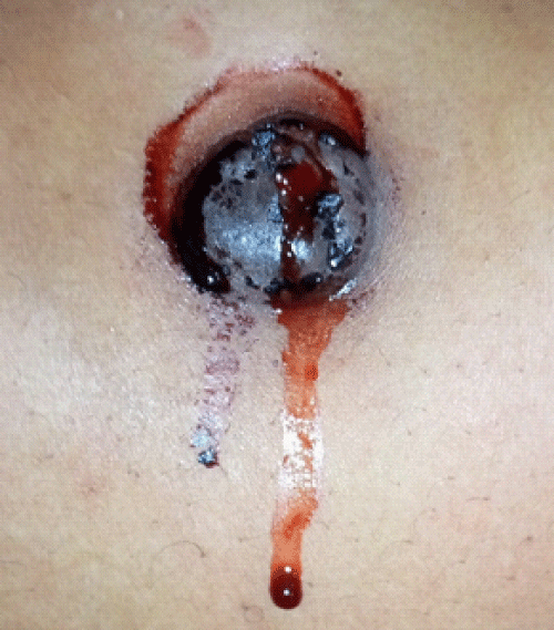Menstruating primary umbilicus cutaneous endometriosis: A case report and  review of literature