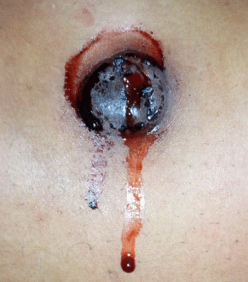 Menstruating primary umbilicus cutaneous endometriosis: A case